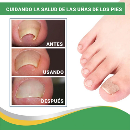 Encravax - Parches Para Hongos y Uñas Encarnadas (PIDE 10 y LLEVA 20)
