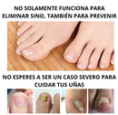 Tratamiento para eliminar Hongos de uña 100% Natural🍃 - ¡Compra 1 y llévate 2 gratis!